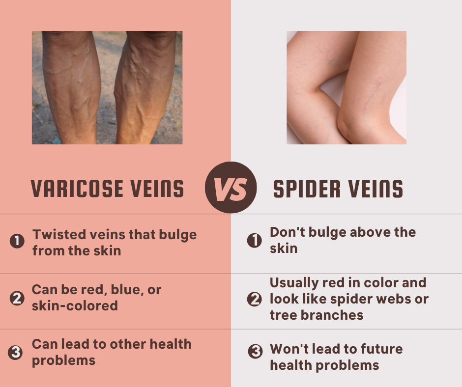 Varicose Veins Versus Spider Veins - MIMIT Health